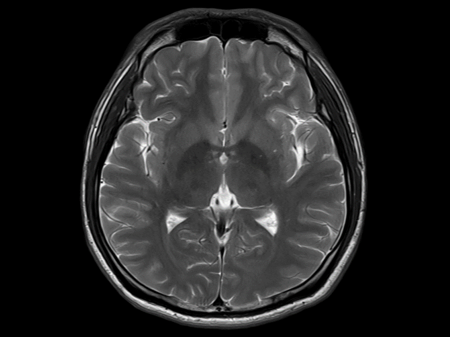 Neuro MRI T1 · axial